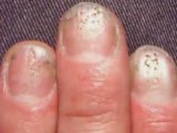 Moderate to Severe Psoriasis