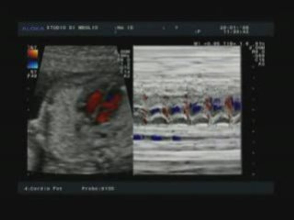 Ecocardiografia Fetale