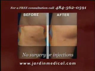 Thermage Treatment: Tighten and Smooth Your Skin