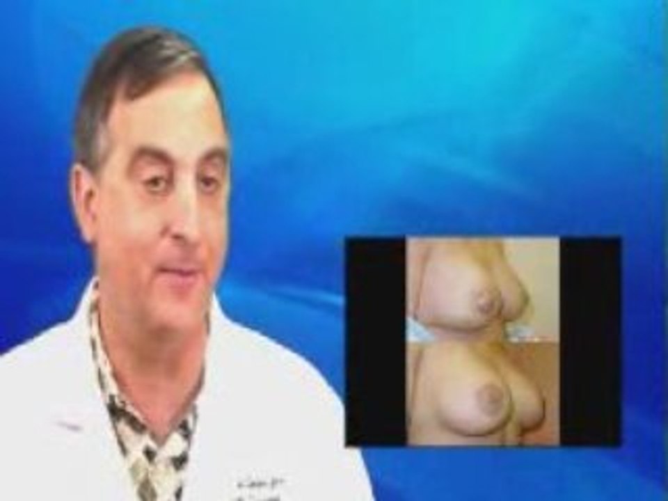 Mastopexy - Breast lift surgery in Atlanta