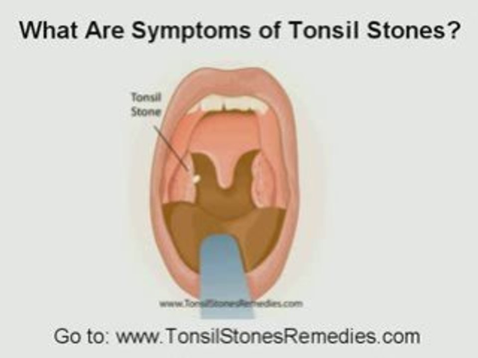 Tonsil Stones Video