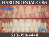 Porcelain Veneers Cincinnati Ohio | Hardin Dental