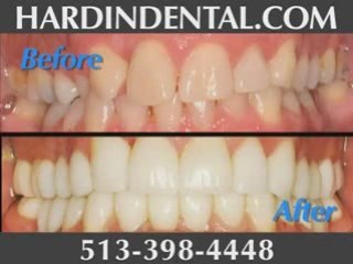 Porcelain Veneers Cincinnati Ohio | Hardin Dental
