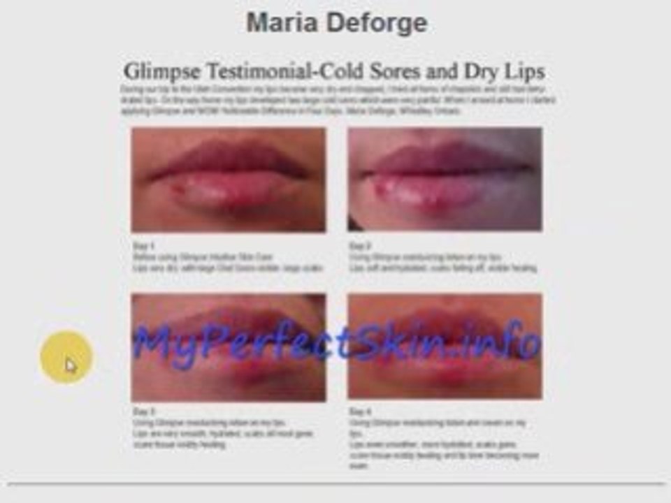Cold Sore Cure?  A Glimpse Testimonial...