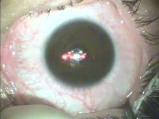 OPERACION MIOPIA POR LASER RAUL MATE GALAN DOCTOR JORGE ALIO