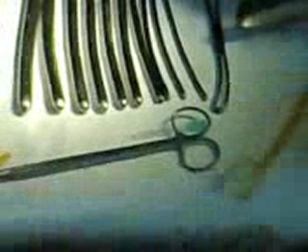 modified thermal balloon endometrial ablation