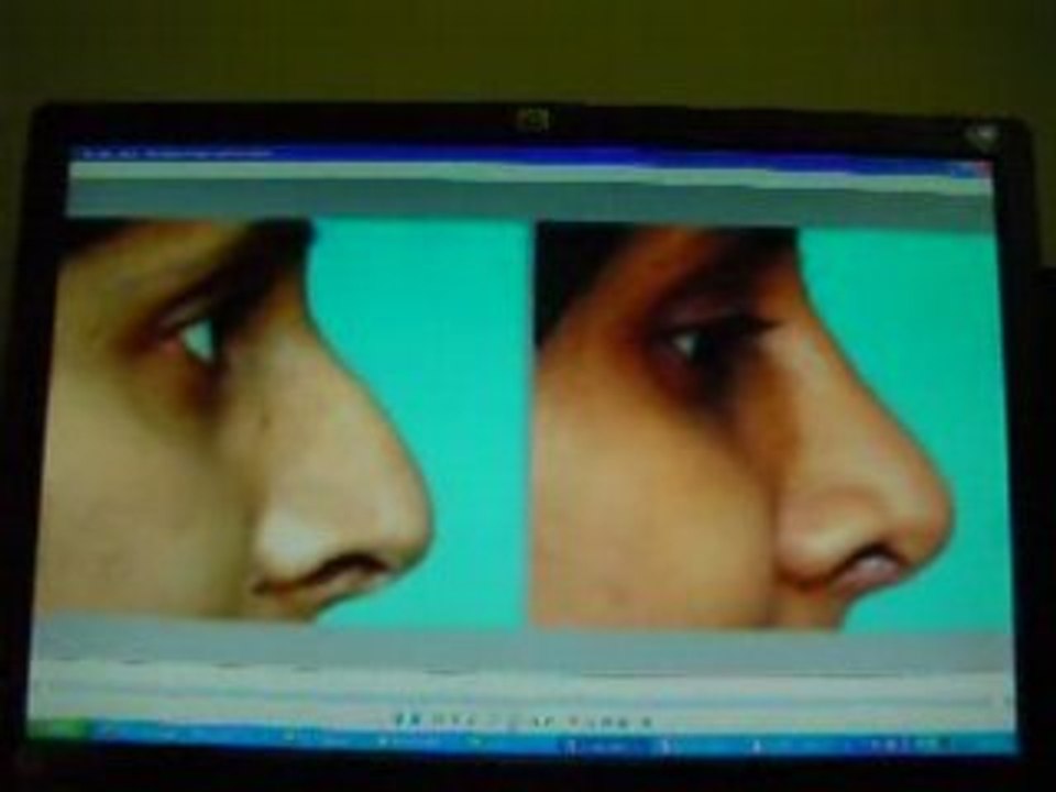 تجميل الانف_جراحة تجميل الانف_عملية جراحة الانف-rhinoplasty
