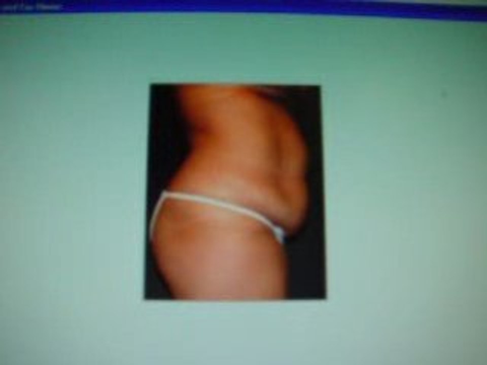 -TUMMY    TUCK-BREAST    AUGMENTATION  BY SILICON FILLED