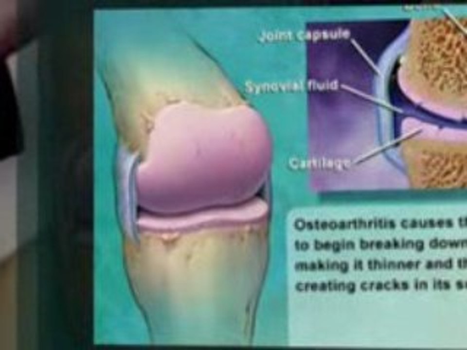 Osteoarthritis Is Common - Get Uncommon Relief With OmegaXL
