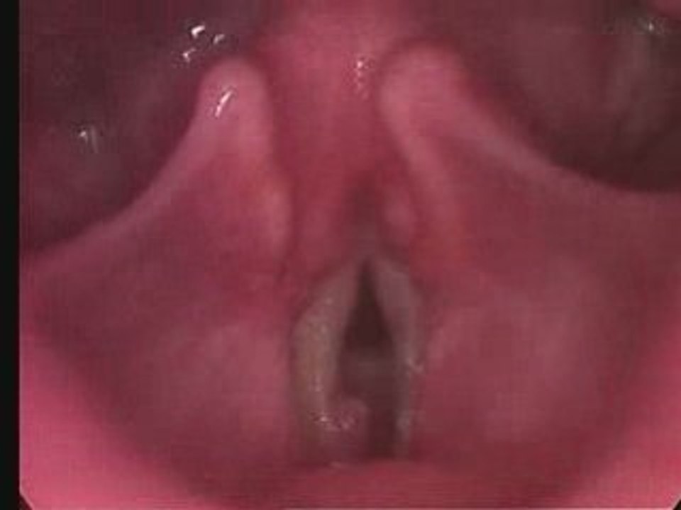 Frank's Vocal Cords: Pre-Surgery
