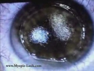 Lasik tout laser en 2 minutes
