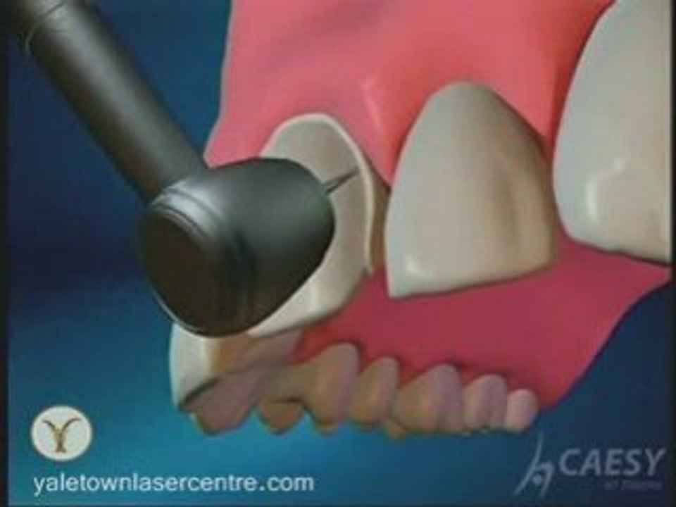 Transform Your Smile For the Better with Dental Veneers