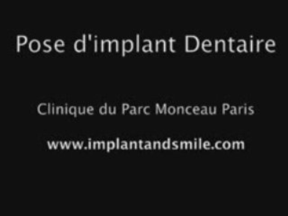 Pose d'un implant dentaire clinique du parc monceau paris