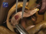 Nueva técnica quirúrg. para extirpar tumores benigno pancrea