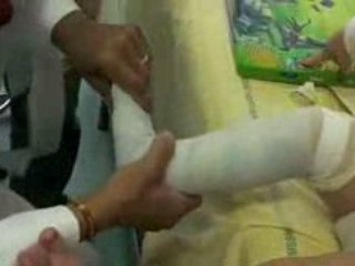 Fabrication d'une attelle courte pied bot varus équin