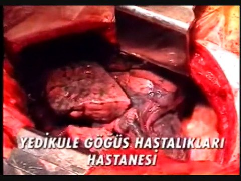 Sigaranın Zararları