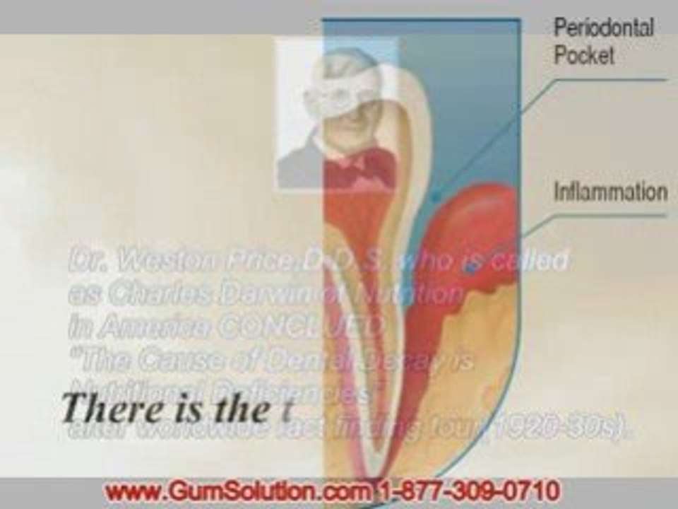 swollen gums treatment,swollen bleeding gums in Los Angeles