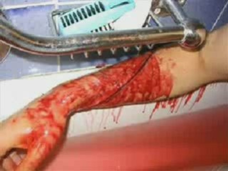 Ausseinandersetzung mit Ritzen