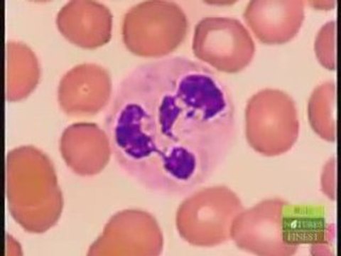 PolyDerm effective for skin cancer, Acne, Zits and Pimples