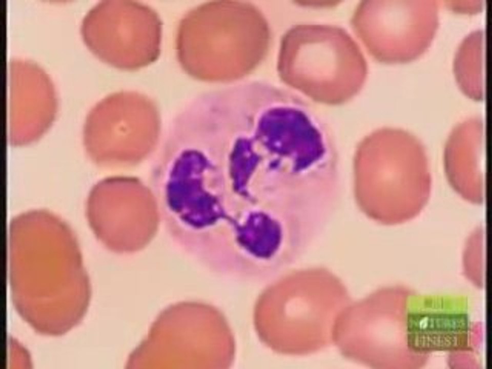 PolyDerm effective for skin cancer, Acne, Zits and Pimples