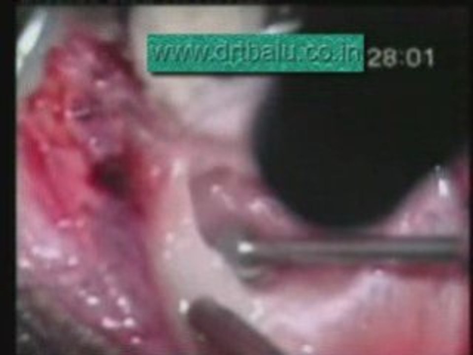 Mastoid