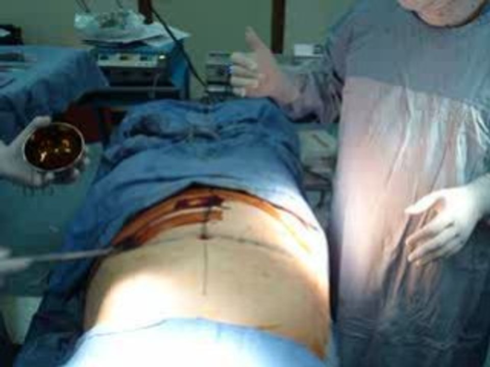 tummy tuck,abdomioplasty,liposuction-VAGINOPLASTY,LABIOPLAST