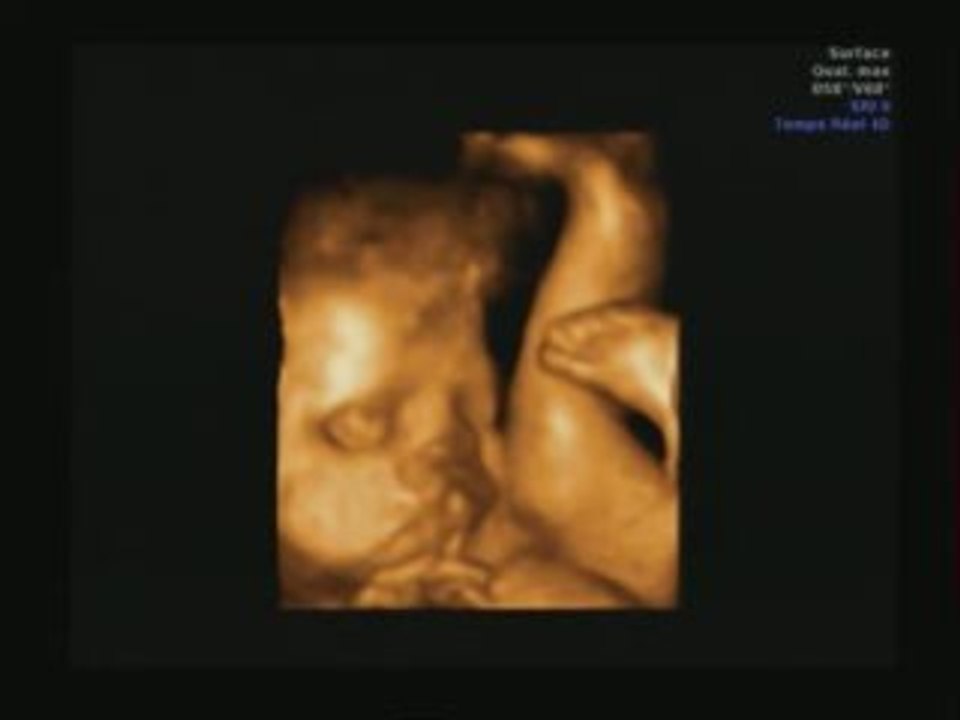 echographie 3d