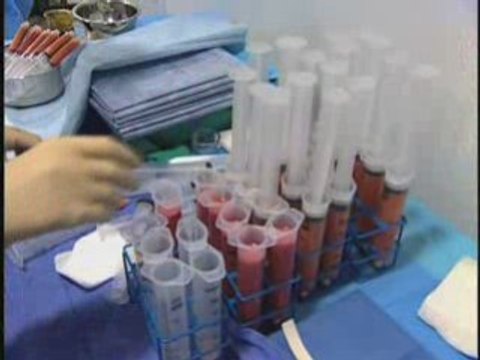 Buttock Implants 90210 | Buttock Lift Beverly Hills CA