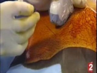 Hernie de Coupole, Diaphragmatique (Doc. : Benachi, Ville)_1