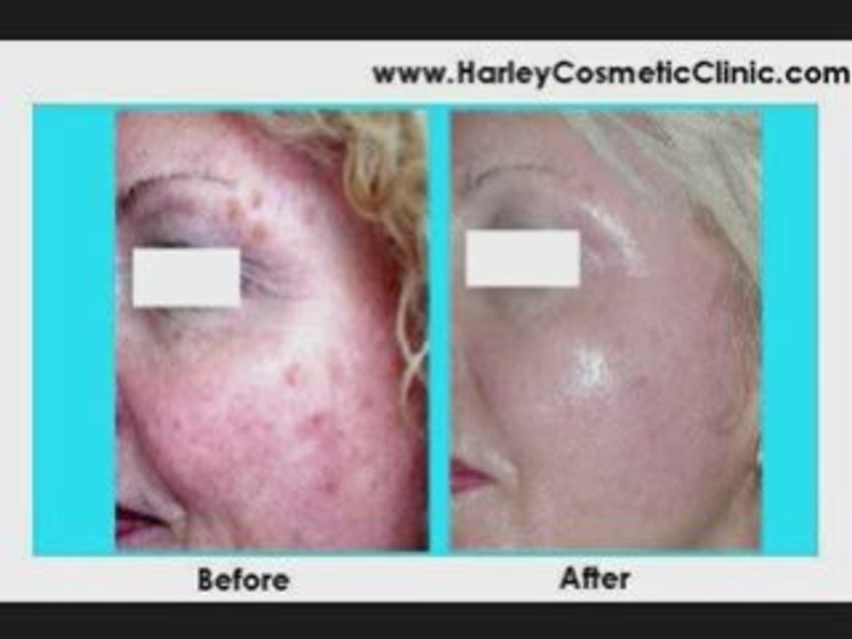 Skin Treatments Harley cosmetic Clinic Acne & Pigmentation