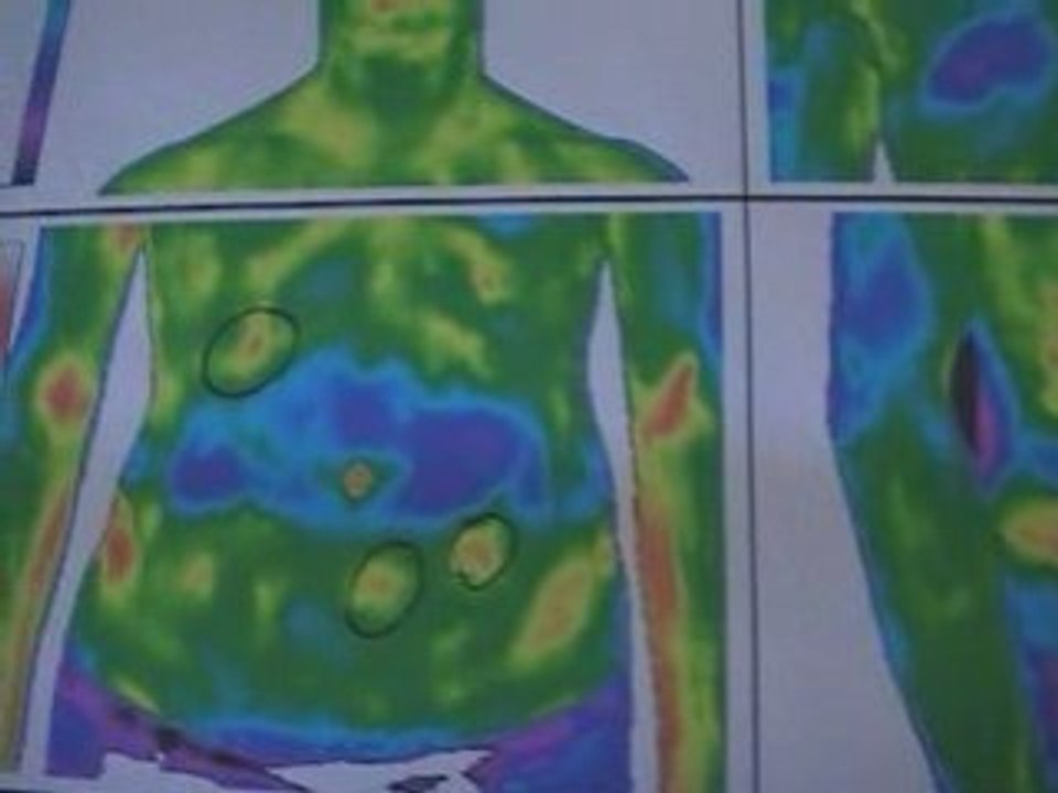 Hasnyálmirigy gyulladás pancreatitis gyógyulása - Táltos