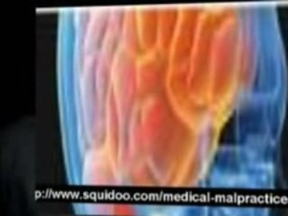 malpractice law