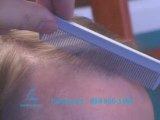 DALLAS HAIR TRANSPLANT:  HAIRLINE AND CENTRAL DENSITY