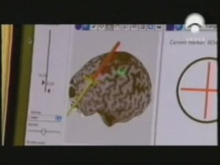 TEC y cerebro: ¿Como funciona la terapia electroconvulsiva?