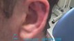 ONE-SIDED (UNILATERAL) OTOPLASTY COSMETIC EAR PINNING DALLAS