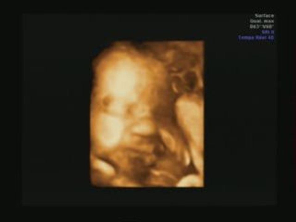Diaporama echographie 3D
