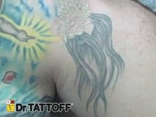 Tattoo Removal - Chest Tattoo
