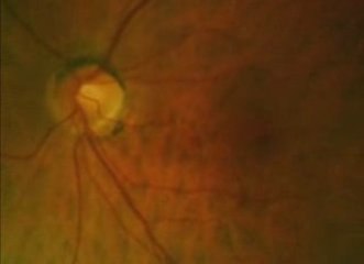 Cerebro procesa información visual incluso en ciegos 🧠