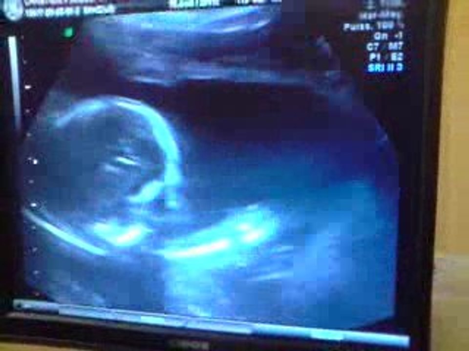 KENZO 5 MOIS DE GROSSESSE