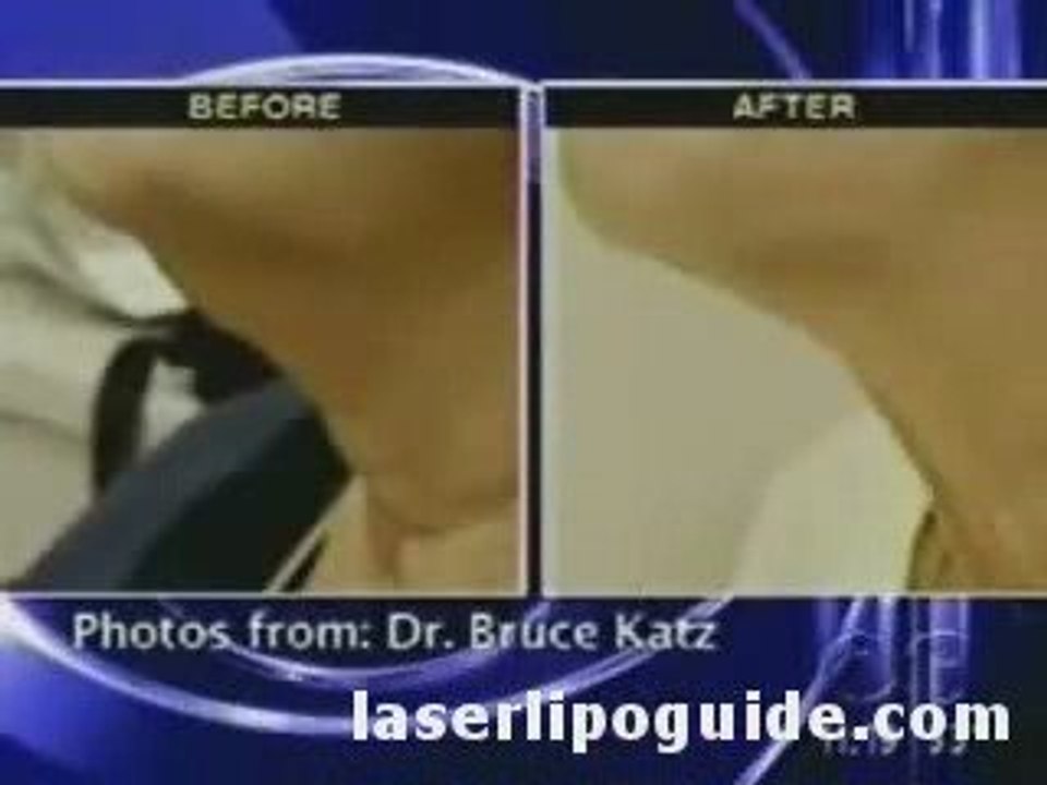 Laser Lipo