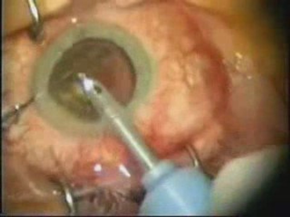 Cataract Eye Surgery  Family Hospital Mumbai India