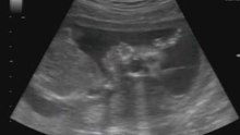 BabySchatzim 17+6