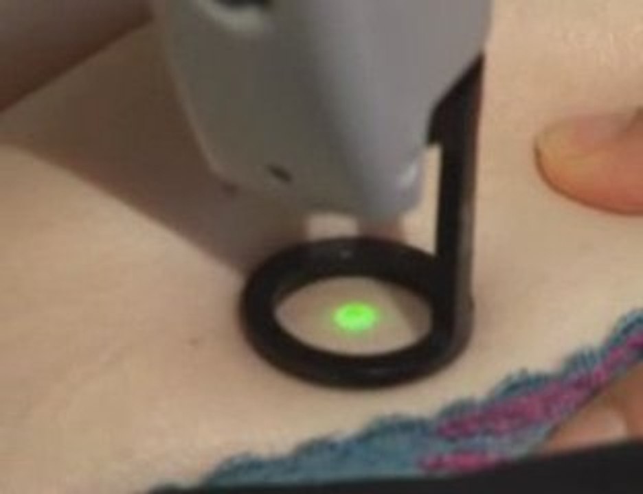 Traitement des taches rubis au laser