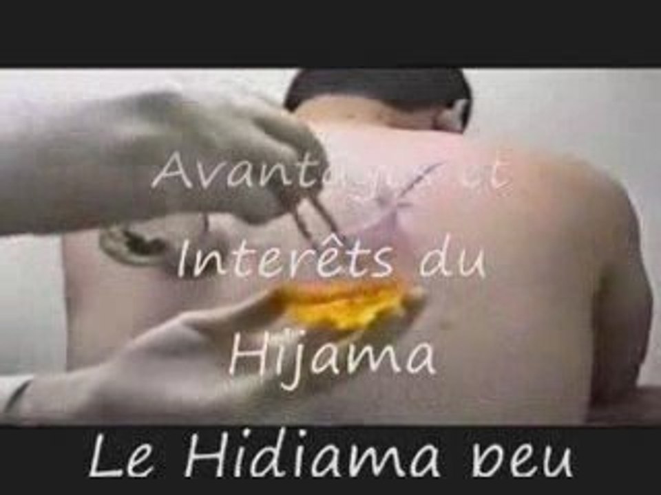 L explication du hijama