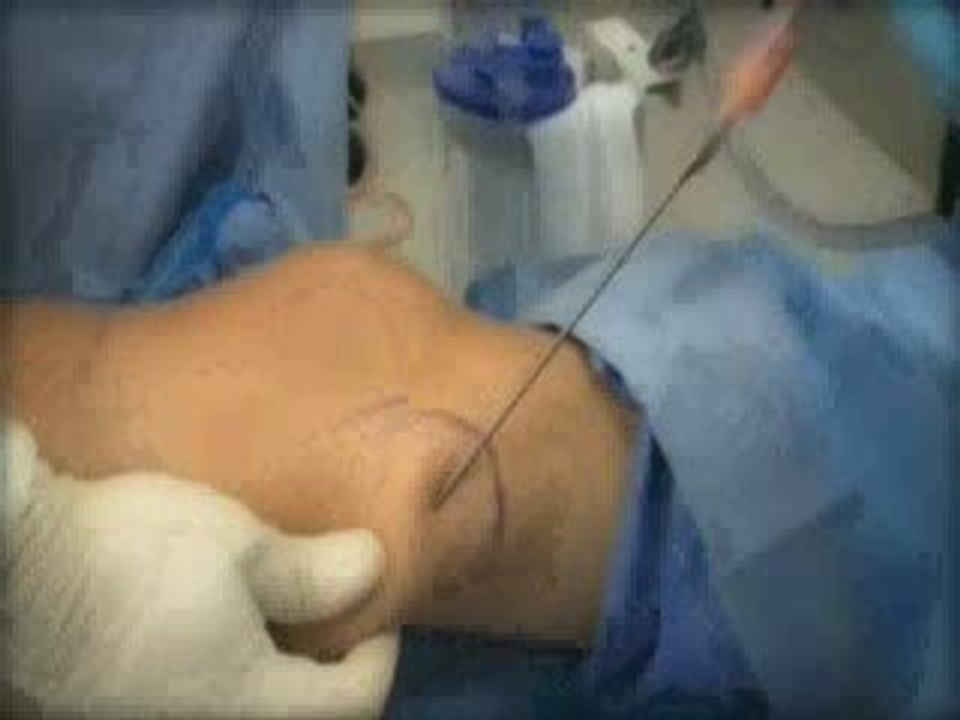 Liposuction Treatments