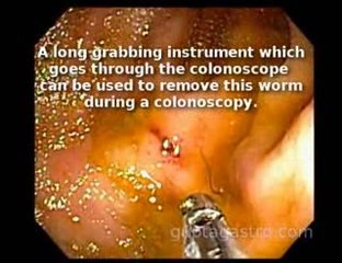 Whip Worm Trichuris Trichiura found during Colonoscopy in NY