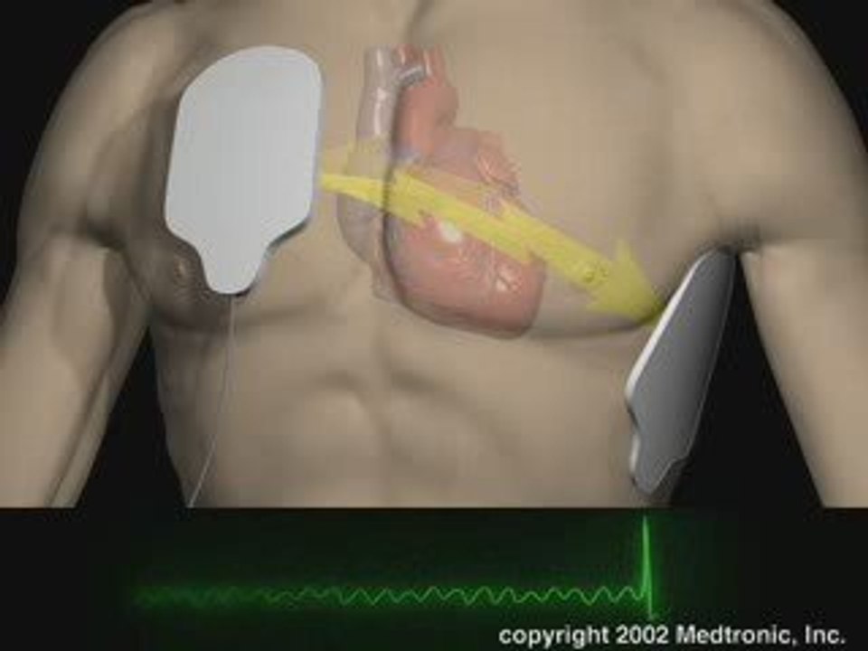 animation d'un choc cardio-électrique