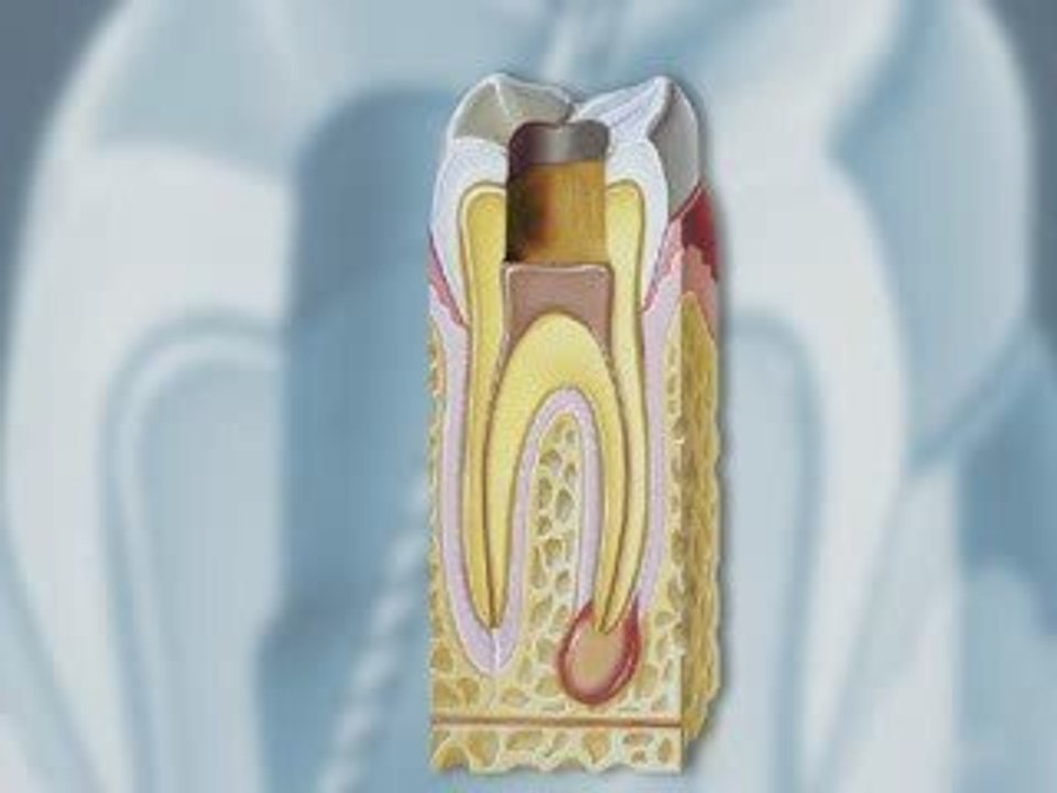 Dental Patient Education - Root Canal