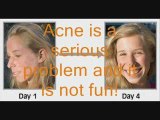Acne Free! A natural program without medications!