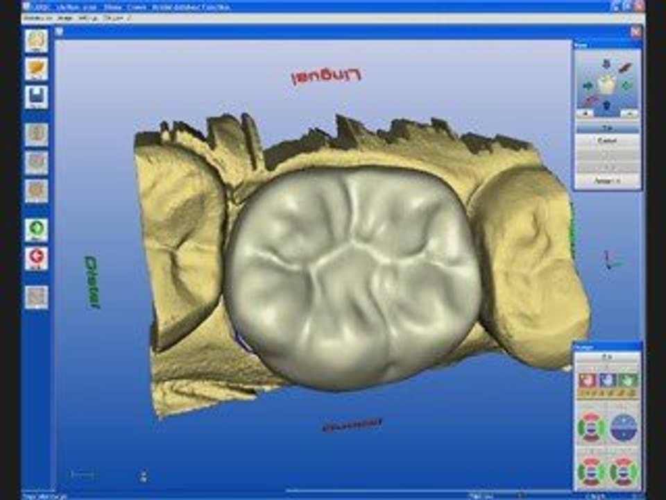 San Diego dentist performs 1-visit CEREC CAD/CAM dentistry